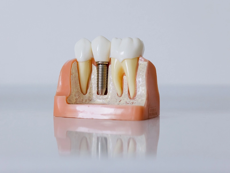 Consulta para implantes dentales